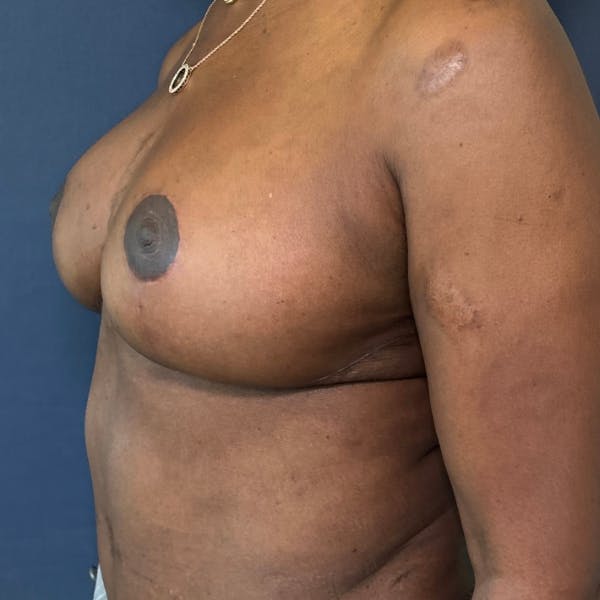 NaturaBra® Mastopexy Before & After Gallery - Patient 180380 - Image 3