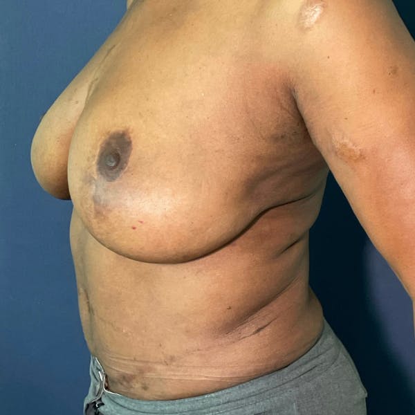 NaturaBra® Mastopexy Before & After Gallery - Patient 180380 - Image 4