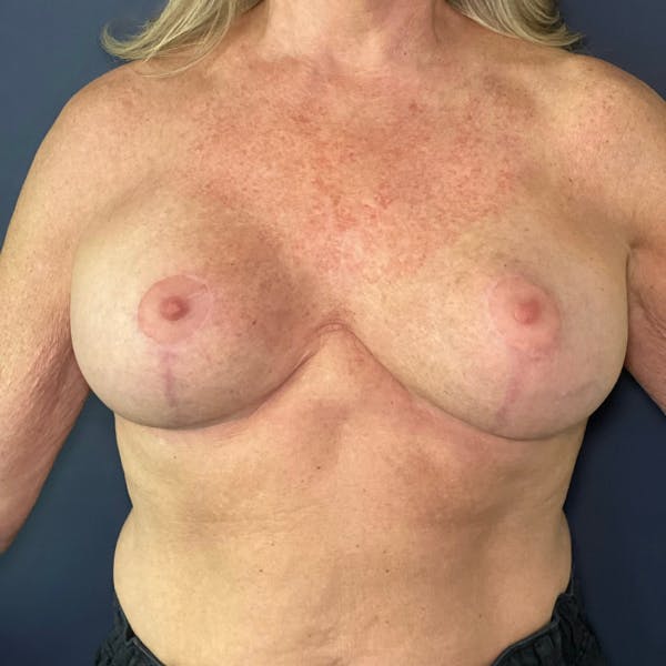 Breast Augmentation Before & After Gallery - Patient 399782 - Image 2