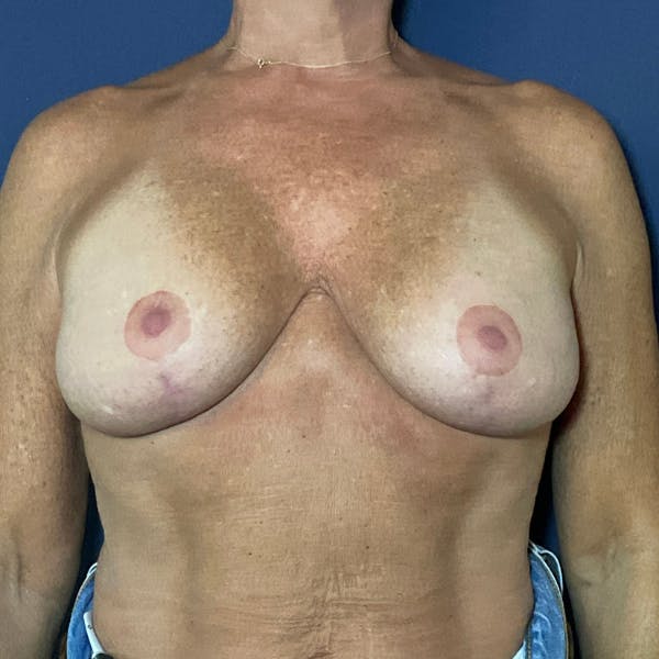 Breast Augmentation Before & After Gallery - Patient 399782 - Image 1