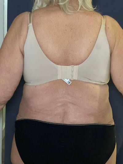 Tummy Tuck (Abdominoplasty) Before & After Gallery - Patient 574273 - Image 4