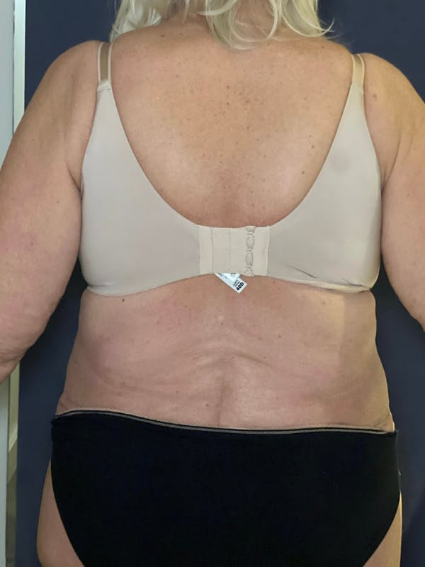 Tummy Tuck (Abdominoplasty) Before & After Gallery - Patient 574273 - Image 4