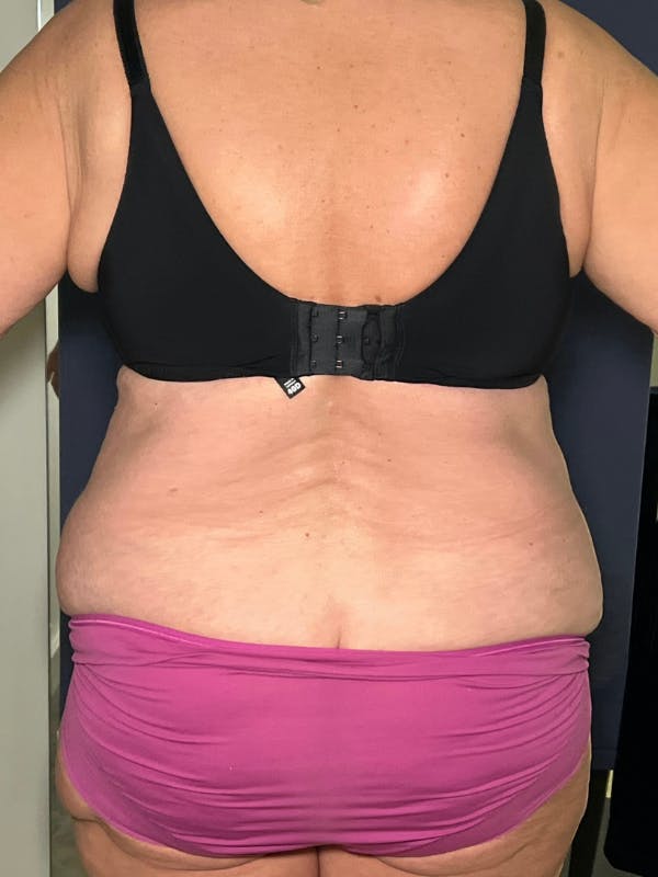Tummy Tuck (Abdominoplasty) Before & After Gallery - Patient 574273 - Image 3