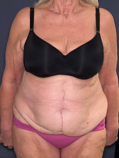 Tummy Tuck (Abdominoplasty) Before & After Gallery - Patient 574273 - Image 1