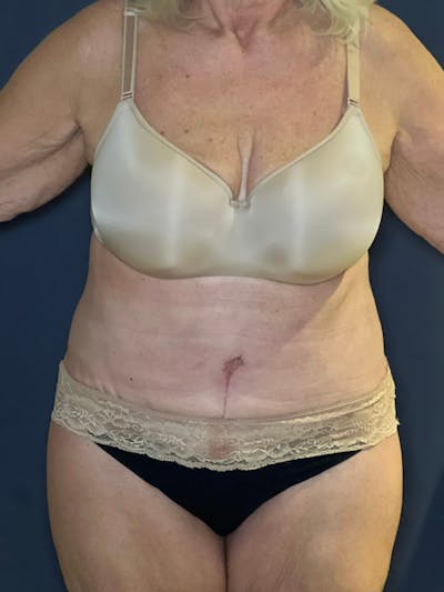 Tummy Tuck (Abdominoplasty) Before & After Gallery - Patient 574273 - Image 2