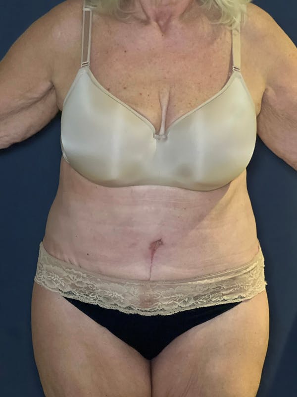 Tummy Tuck (Abdominoplasty) Before & After Gallery - Patient 574273 - Image 2