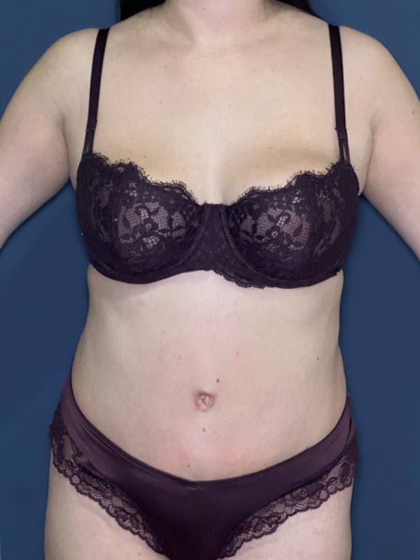 Tummy Tuck (Abdominoplasty) Before & After Gallery - Patient 348225 - Image 2