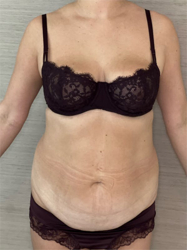 Tummy Tuck (Abdominoplasty) Before & After Gallery - Patient 348225 - Image 1
