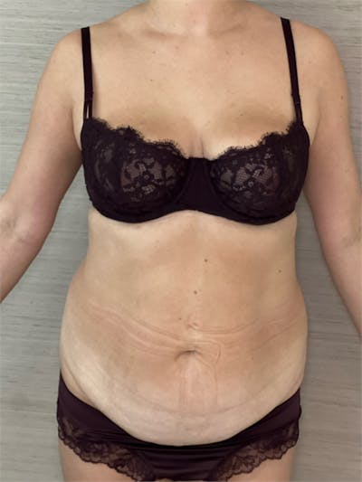 Tummy Tuck (Abdominoplasty) Before & After Gallery - Patient 348225 - Image 1