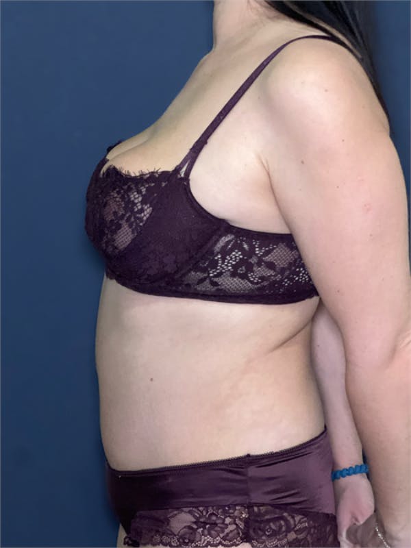 Tummy Tuck (Abdominoplasty) Before & After Gallery - Patient 348225 - Image 4
