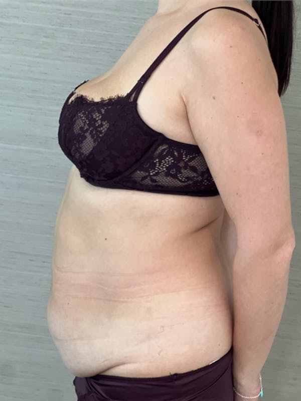 Tummy Tuck (Abdominoplasty) Before & After Gallery - Patient 348225 - Image 3
