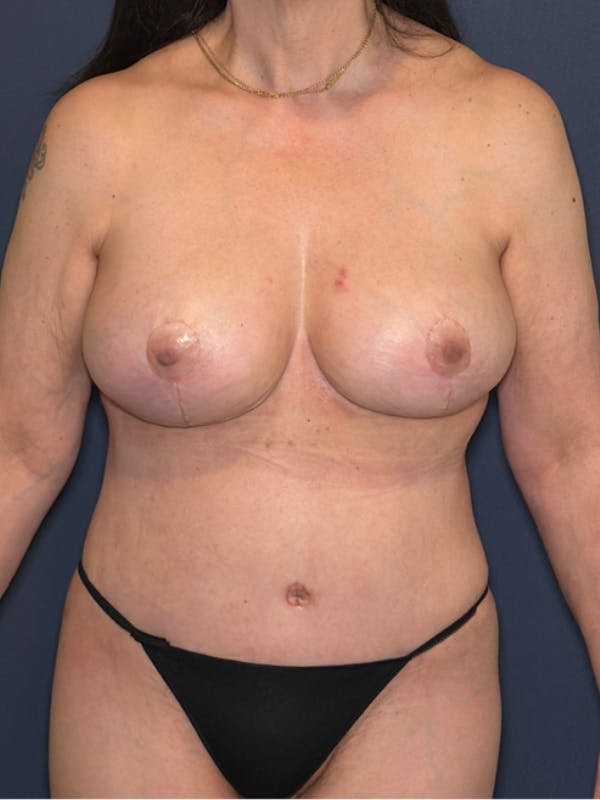 Torso Lift Before & After Gallery - Patient 124550 - Image 2