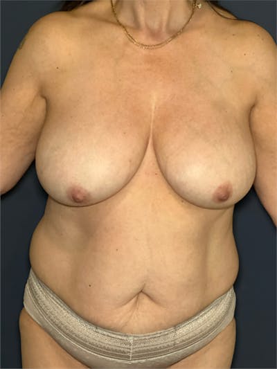 NaturaBra® Mastopexy Before & After Gallery - Patient 315973 - Image 1