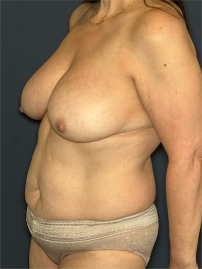 NaturaBra® Mastopexy Before & After Gallery - Patient 315973 - Image 4