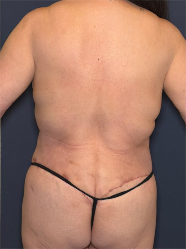 Torso Lift Before & After Gallery - Patient 124550 - Image 8