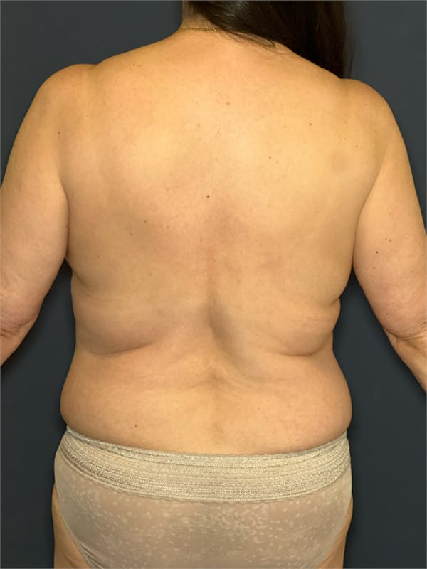 Torso Lift Before & After Gallery - Patient 124550 - Image 7