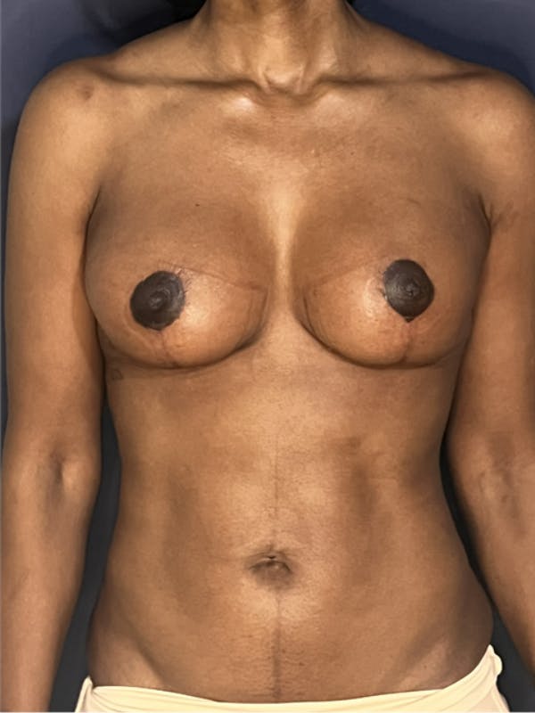 NaturaBra® Mastopexy Before & After Gallery - Patient 387666 - Image 2