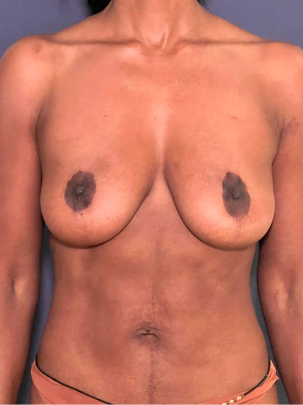 NaturaBra® Mastopexy Before & After Gallery - Patient 387666 - Image 1