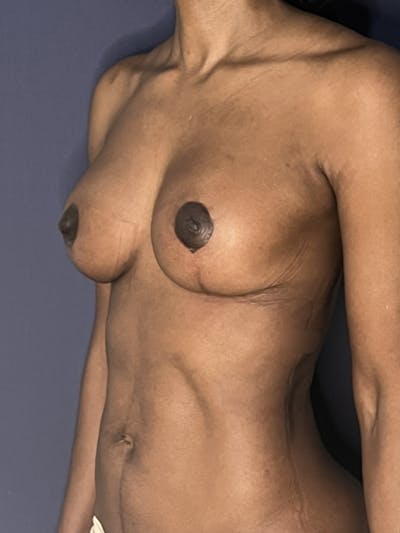 NaturaBra® Mastopexy Before & After Gallery - Patient 387666 - Image 4