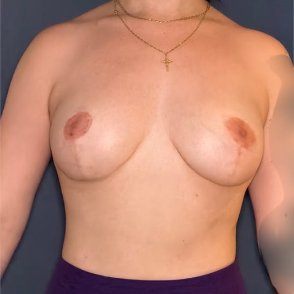 NaturaBra® Mastopexy Before & After Gallery - Patient 318668 - Image 2
