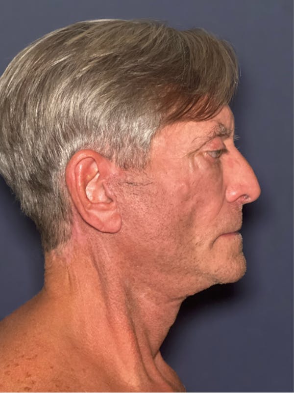 Facelift Before & After Gallery - Patient 418678 - Image 4