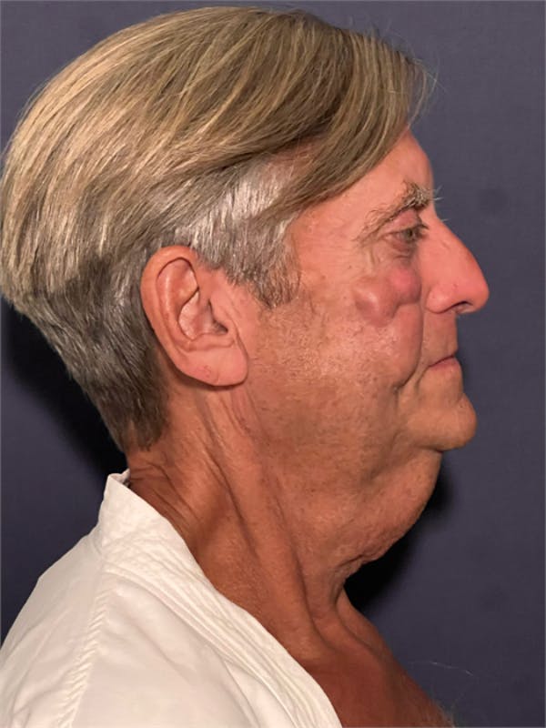 Facelift Before & After Gallery - Patient 418678 - Image 3