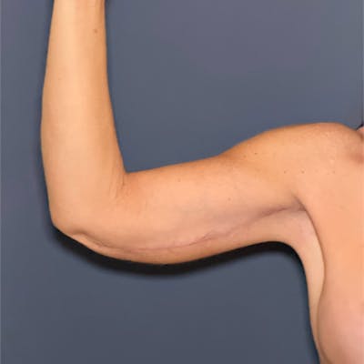 Arm Lift Before & After Gallery - Patient 229312 - Image 2