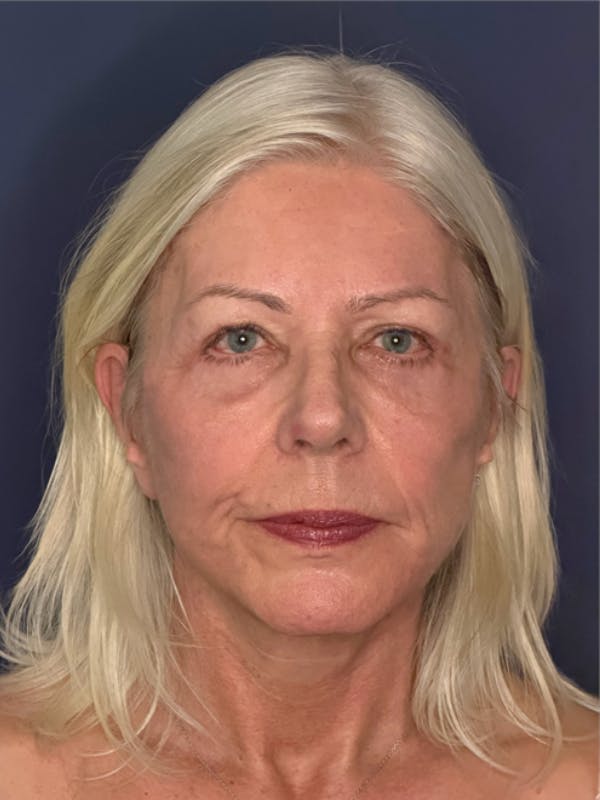 Neck Lift Before & After Gallery - Patient 303289 - Image 2