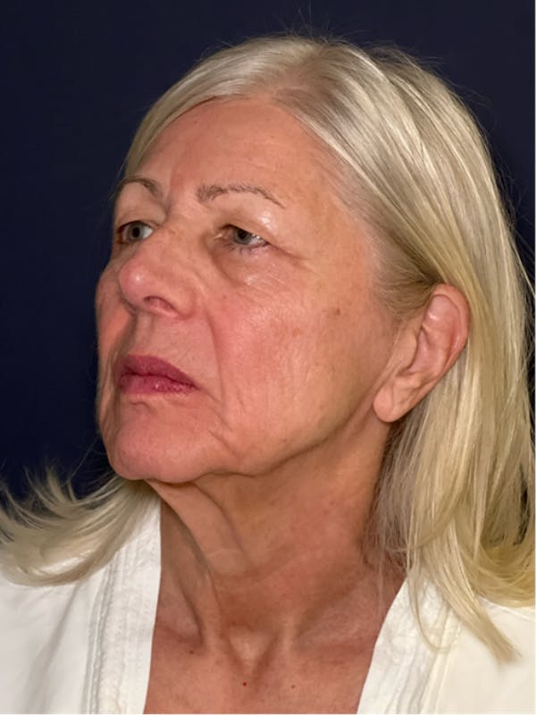 Neck Lift Before & After Gallery - Patient 303289 - Image 3