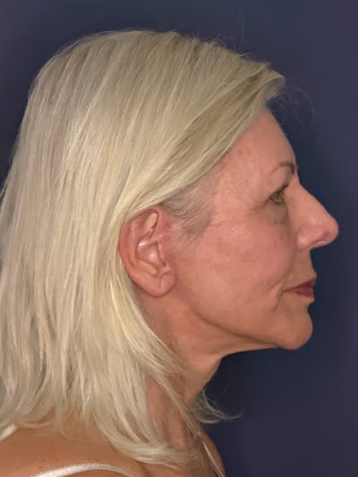 Neck Lift Before & After Gallery - Patient 303289 - Image 6