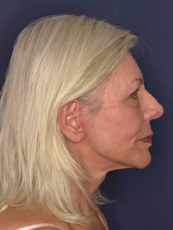 Neck Lift Before & After Gallery - Patient 303289 - Image 6
