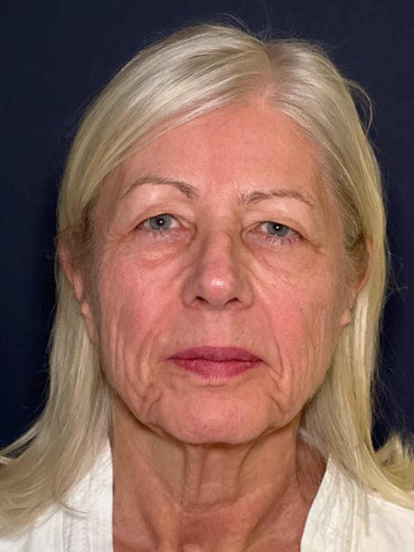 Neck Lift Before & After Gallery - Patient 303289 - Image 1