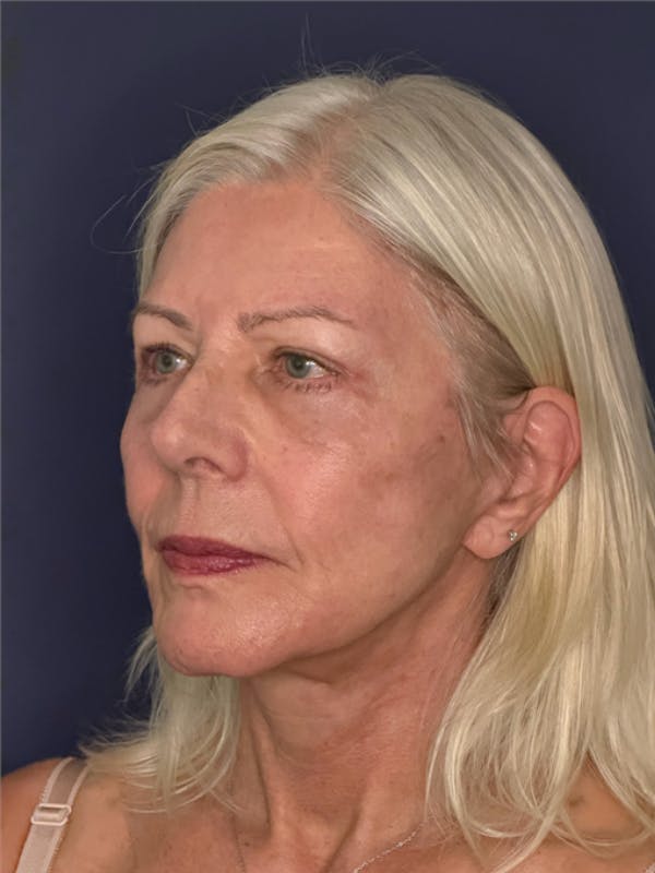 Neck Lift Before & After Gallery - Patient 303289 - Image 4