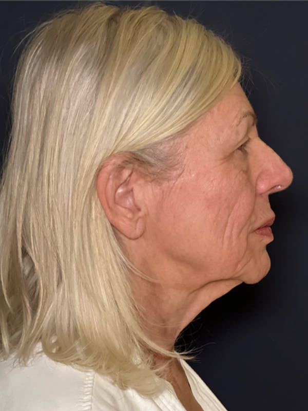 Neck Lift Before & After Gallery - Patient 303289 - Image 5
