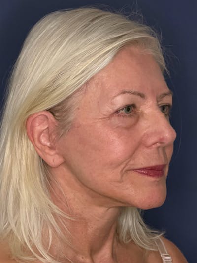Neck Lift Before & After Gallery - Patient 303289 - Image 8