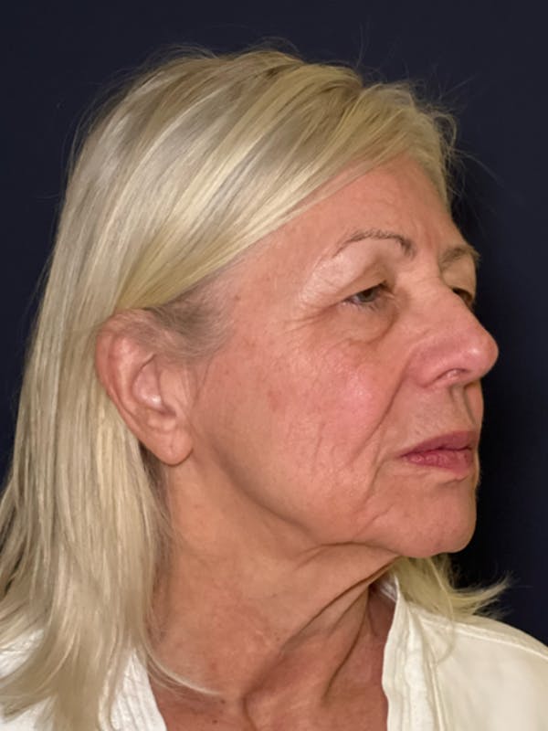 Neck Lift Before & After Gallery - Patient 303289 - Image 7