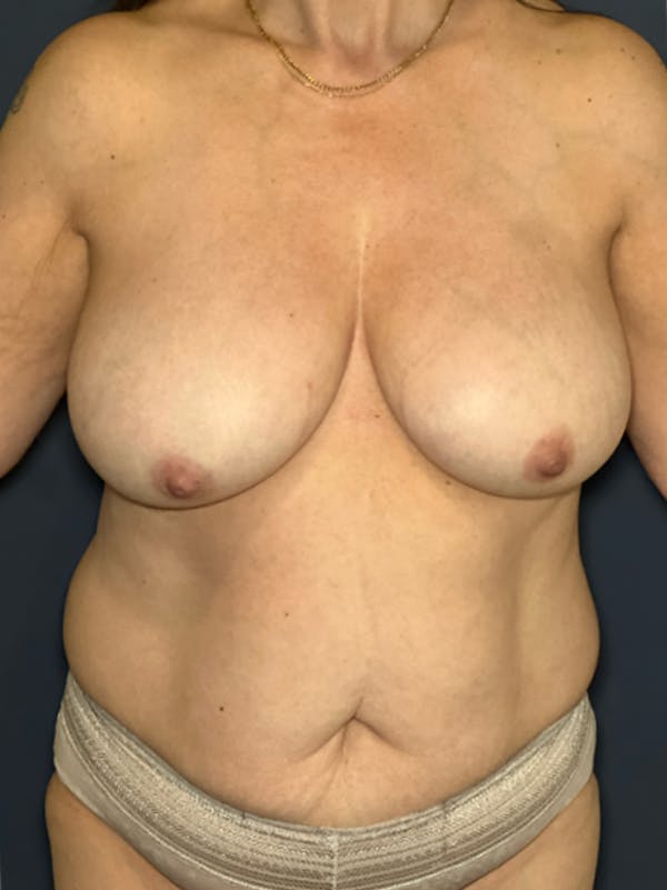 Torso Lift Before & After Gallery - Patient 124550 - Image 1