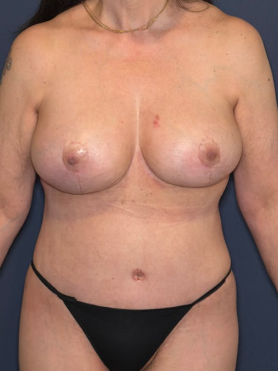 NaturaBra® Mastopexy Before & After Gallery - Patient 315973 - Image 2