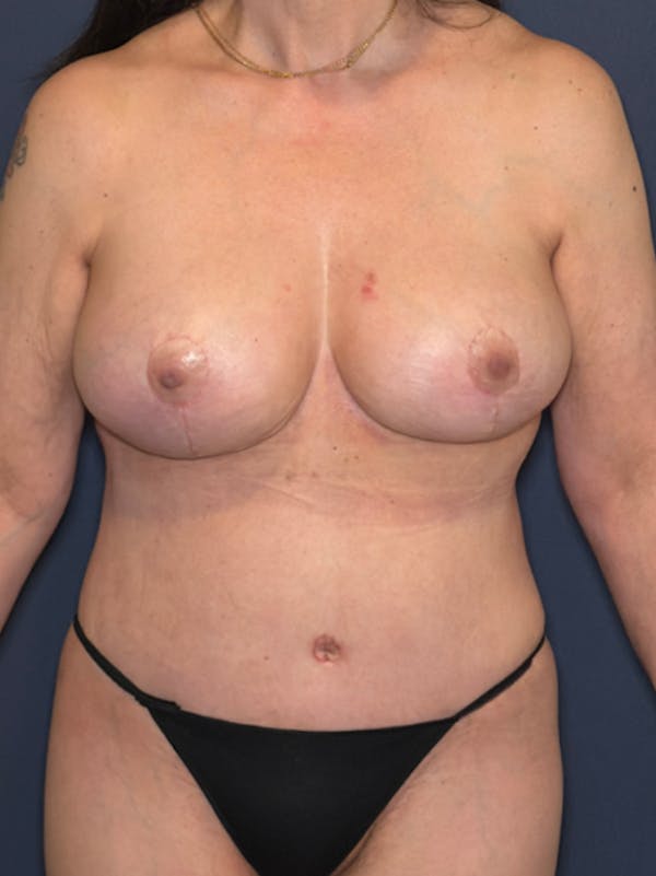 Torso Lift Before & After Gallery - Patient 124550 - Image 2