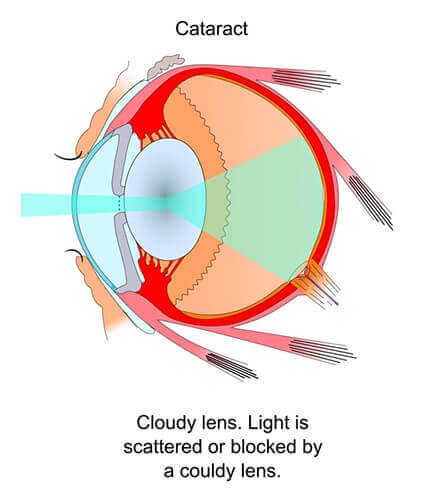cataract infographic