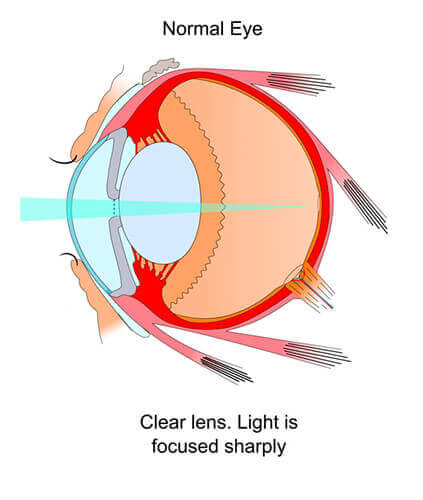 cataract infographic