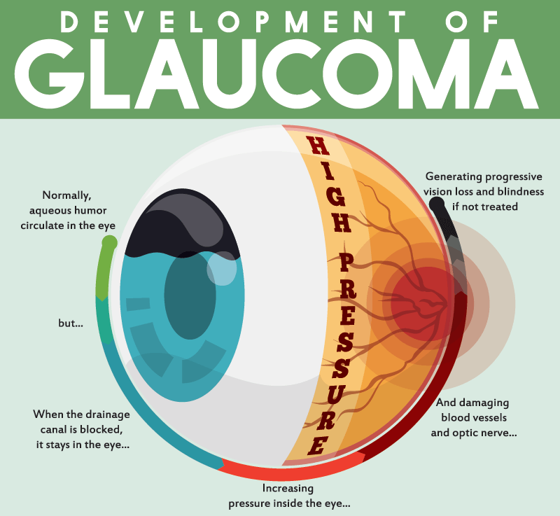 glaucoma infographic