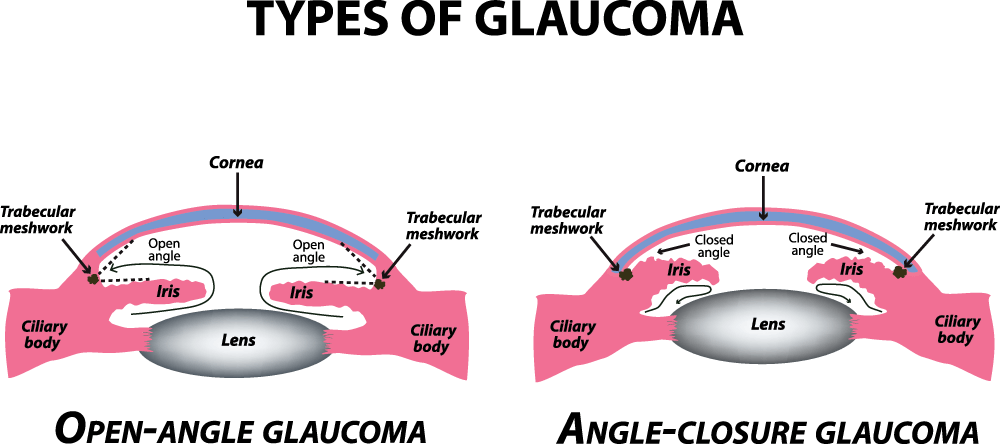 types of glaucoma diagram