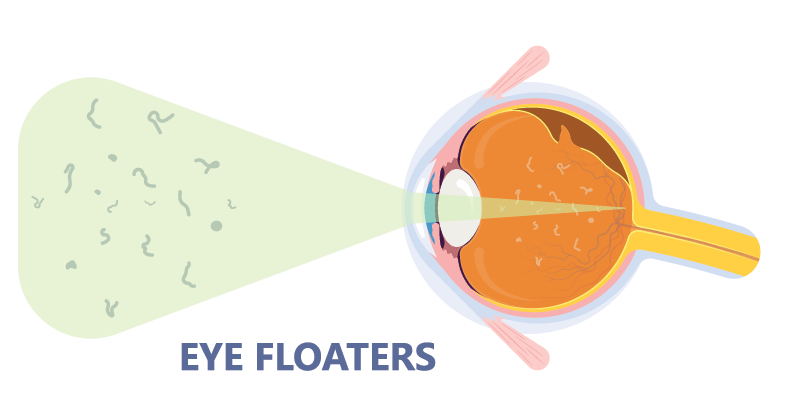 eye floaters graphic
