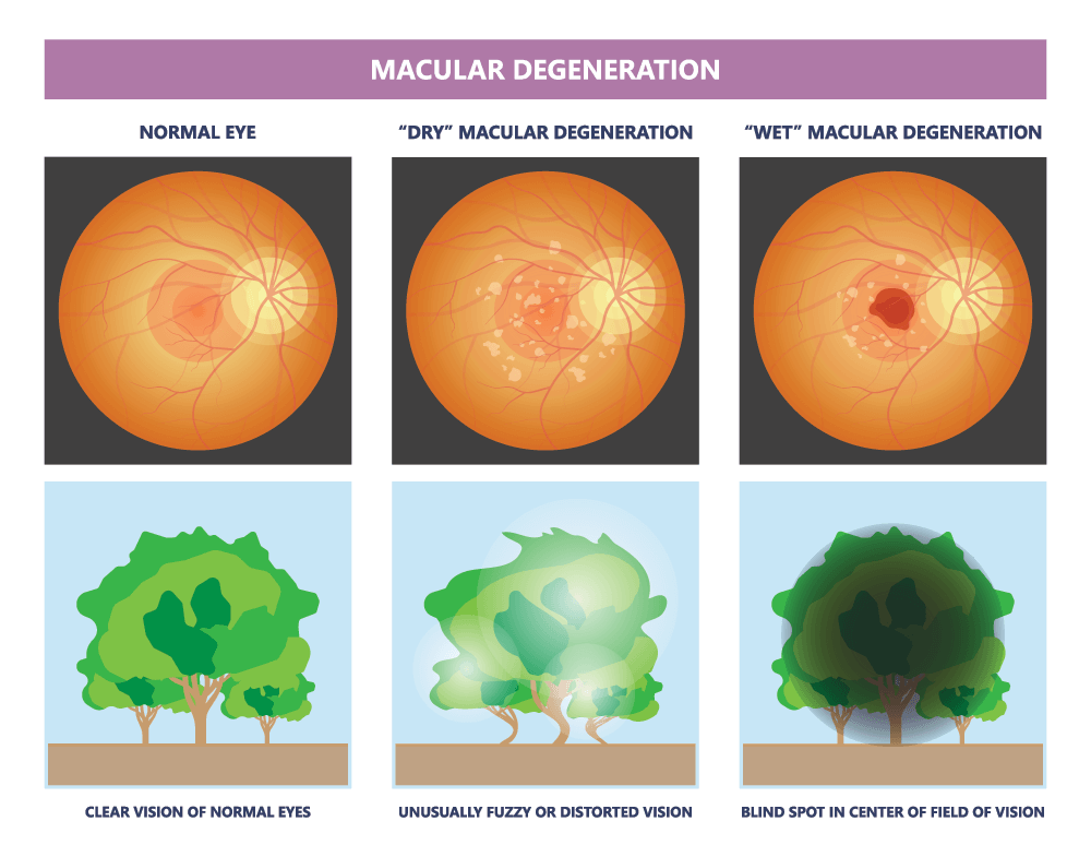Macular Degeneration Diagram