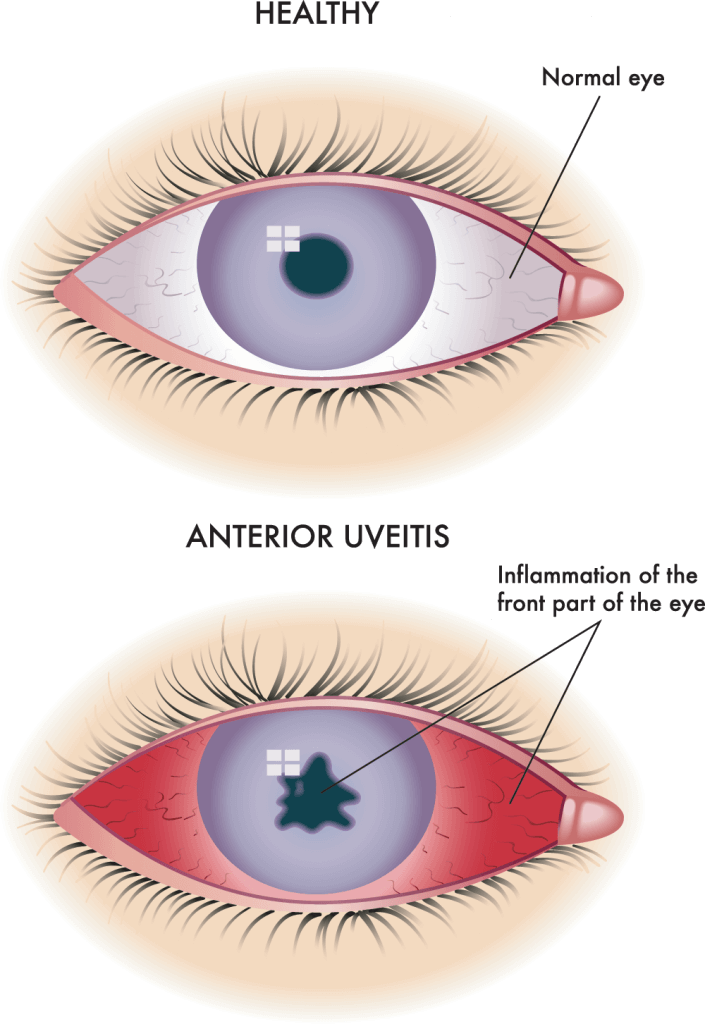 Uveitis Diagram