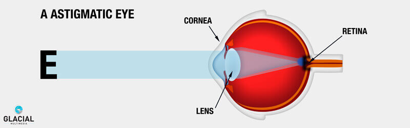 astigmatic eye graphic