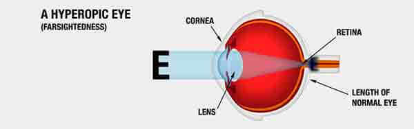 hyperopic eye graphic