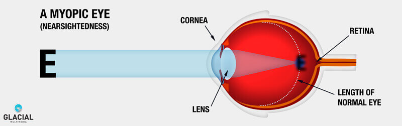 myopic eye graphic