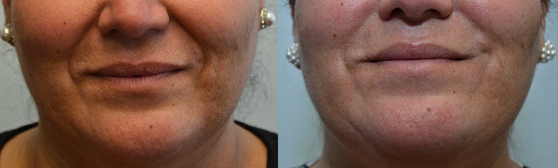 Radiesse Before & After